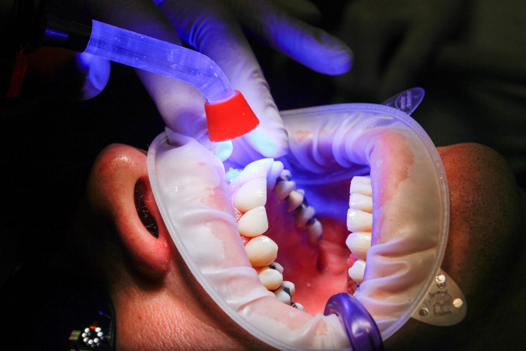 Cavity Dental Filling, Tooth Cavity