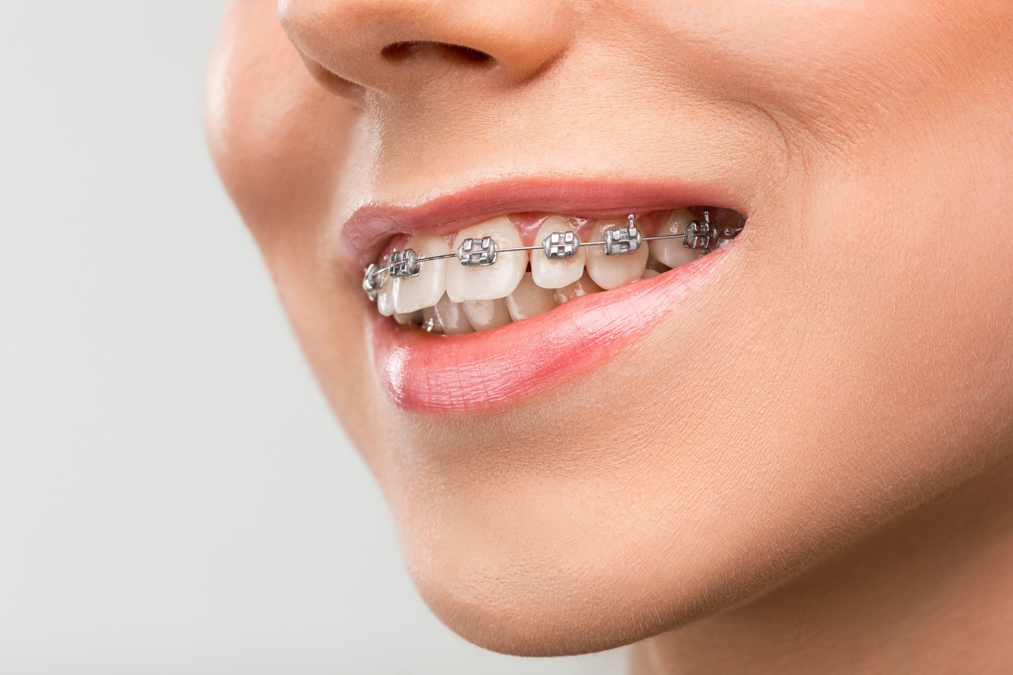 Invisalign vs Braces – We reveal the truth about how they compare