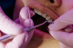 Types Of Braces For Effective Orthodontic Treatment - Abari
