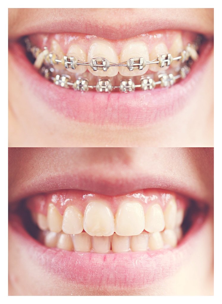 Important Things To Know Before You Get Dental Braces