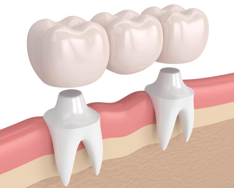 Dental Bridges Types, Benefits, Use Case, And Costs