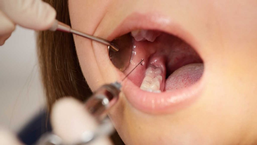 Dental Anesthesia: Types, Side Effects, and Risks