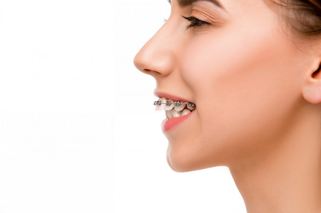 Dental Braces Types, Procedure, Benefits & Costs
